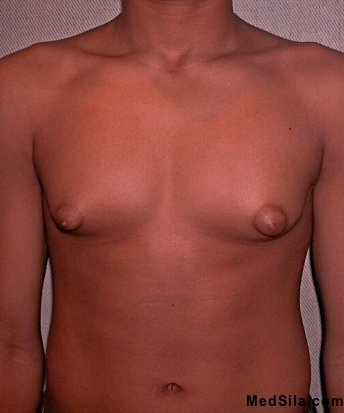 Гинекомастия